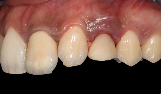 Screw-retained temporary crown seated — buccal view