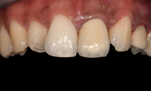 Screw-retained temporary crown seated — occlusal view
