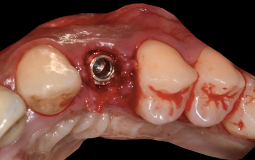 Post-placement view confirming the implant position matches the 3D plan exactly