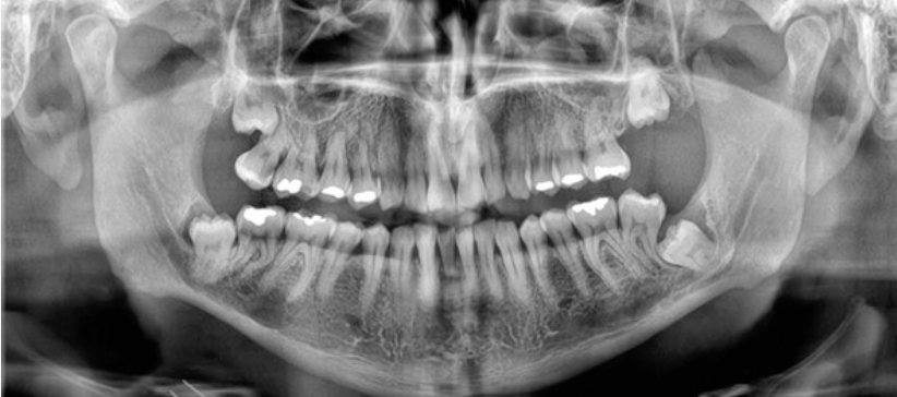Panoramic radiograph showing deeply impacted wisdom teeth in close proximity to the mandibular nerve canals