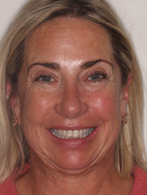 Clinical evaluation of a patient with severe obstructive sleep apnoea