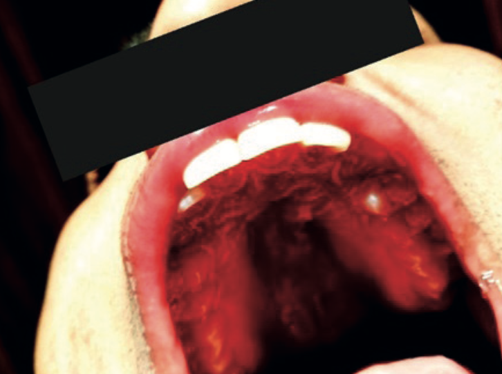Clinical photograph of palatal swelling adjacent to the upper left lateral incisor