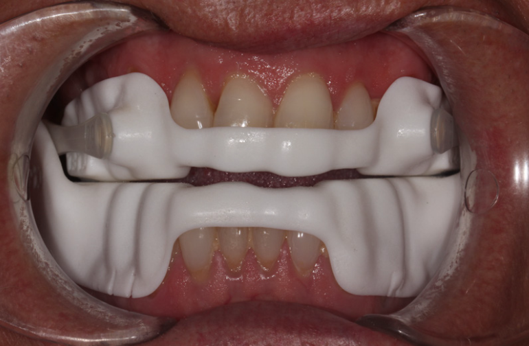 Narval CC mandibular advancement device fitted — view 1