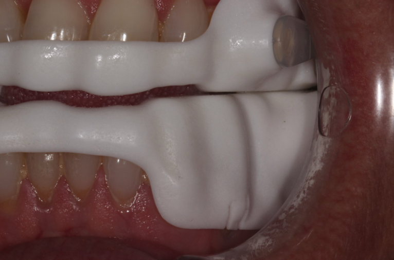 Device fitted and seated — view 2