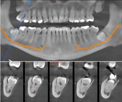 Reconstructed panoramic and cross-sections of tooth 48 showing root contact with the mandibular nerve canal