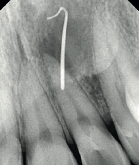 Periapical radiograph of UL2 with sinus tracing — inconclusive for aetiology