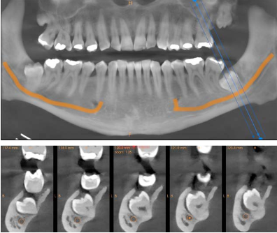 Reconstructed panoramic and cross-sections of tooth 38 showing proximity to the mandibular nerve canal
