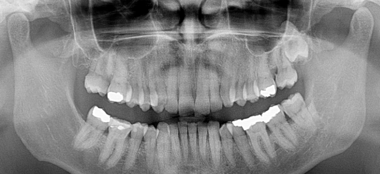 Panoramic radiograph captured on CS 8100