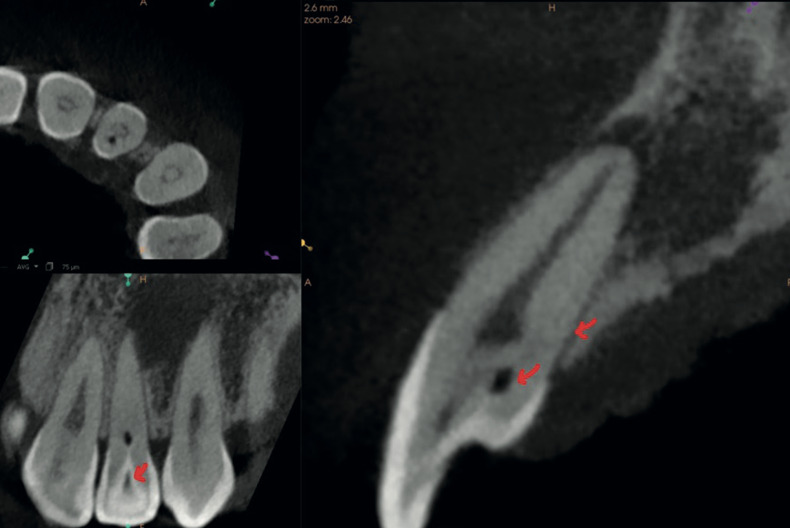 High-resolution CBCT multiplanar view revealing dens invaginatus