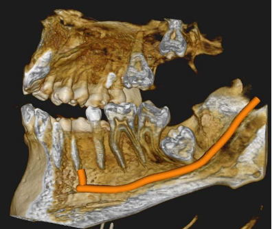 3D volume-rendered view showing the complex relationship between tooth 38 and the mandibular nerve canal