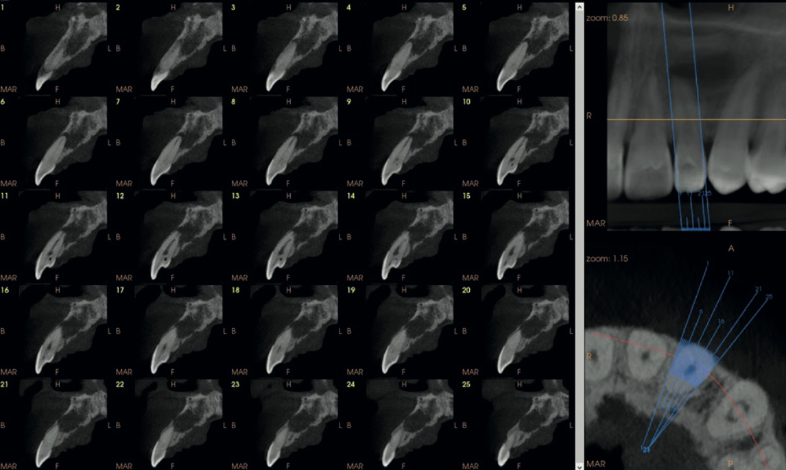Thin serial cross-sections of UL2 from the CS 9600 CBCT showing the dens invaginatus morphology at 75 micron resolution