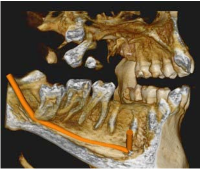 3D volume-rendered view showing the complex relationship between tooth 48 and the mandibular nerve canal