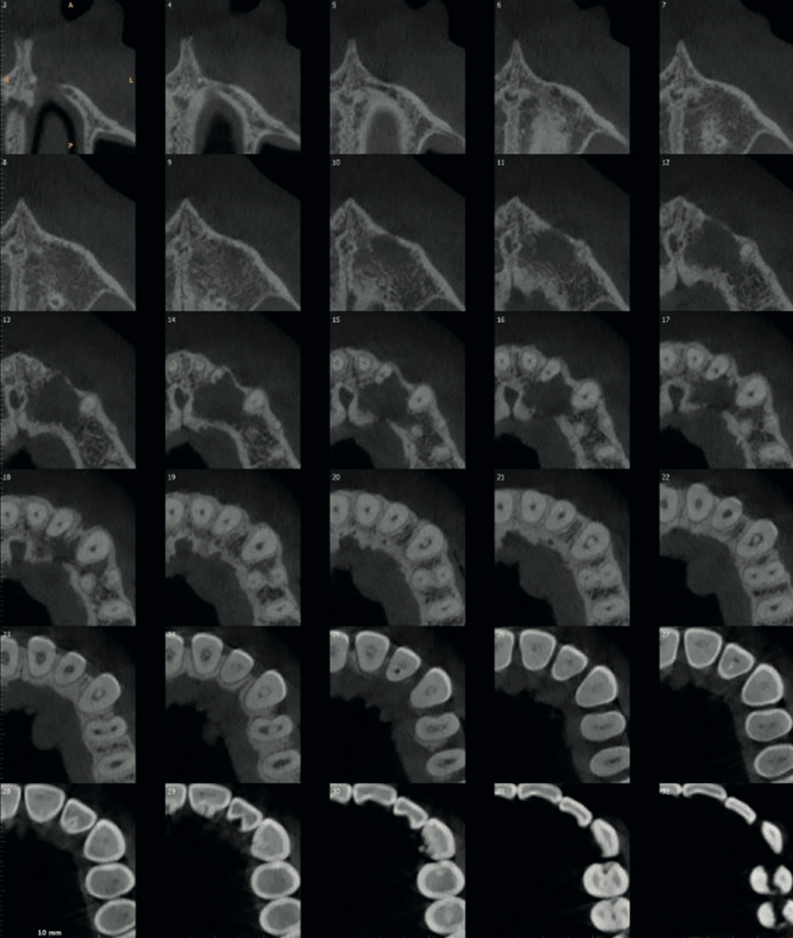 Axial CBCT images showing the full extent of the periapical lesion in the UL2-UL3 region