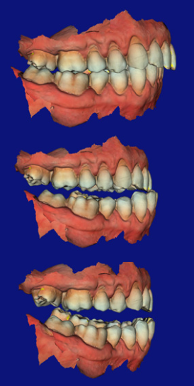 CS 3600 software showing scan data and bite analysis