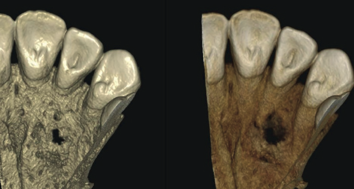 3D volume-rendered view of the affected anterior maxilla