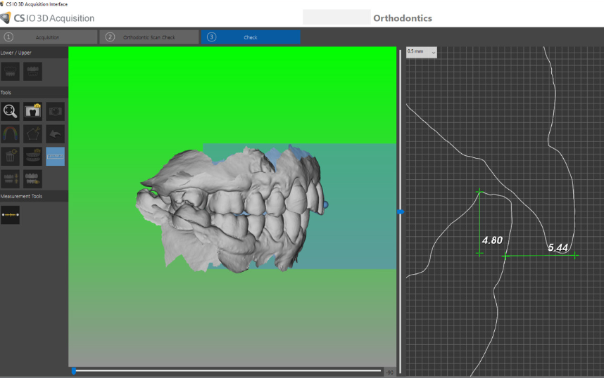 Undercut analysis tools in CS 3600 acquisition software