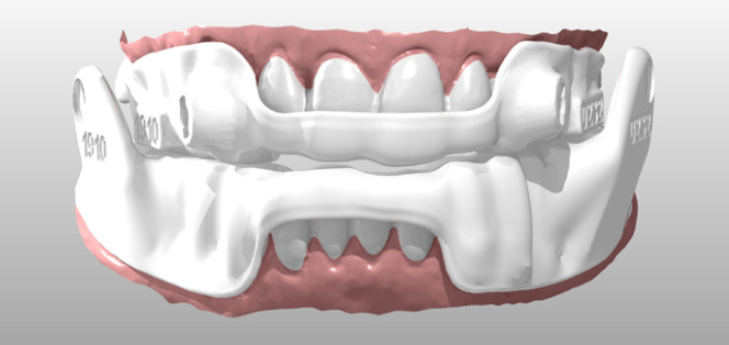 3D model aligned with virtual articulator — view 1