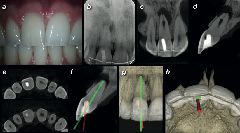 Clinical and CBCT views of a calcified canal in a discoloured upper central incisor requiring endodontic retreatment