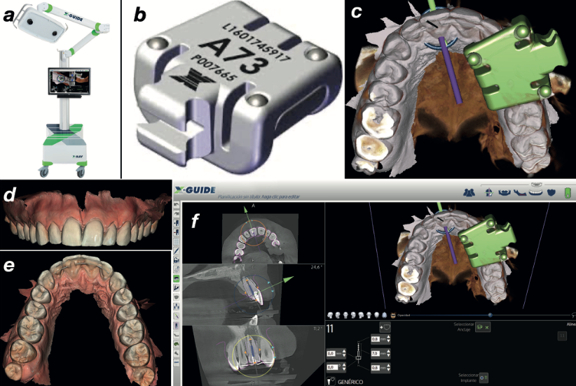Dynamic navigation setup: X-Guide system, X-Clip fiducial device, intraoral scan, and virtual drilling path planning in X-Guide software