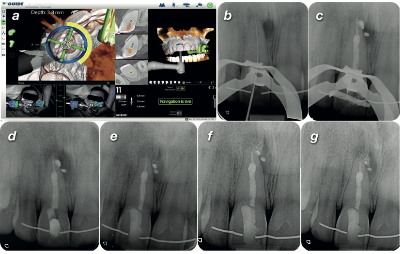 Live dynamic navigation screen and follow-up radiographs