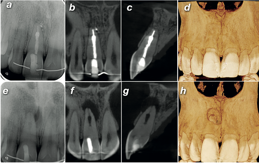 Side-by-side comparison of diagnostic and 12-month follow-up imaging: periapical radiographs, CBCT coronal and sagittal planes, and volume rendering showing complete periapical healing and buccal cortical plate regeneration