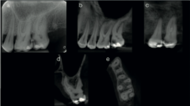 CBCT diagnostic views of complex root canal anatomy in tooth 2.7