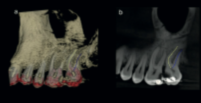 Fig. 2 — Root canal tracing tool applied to the buccal roots of UL7