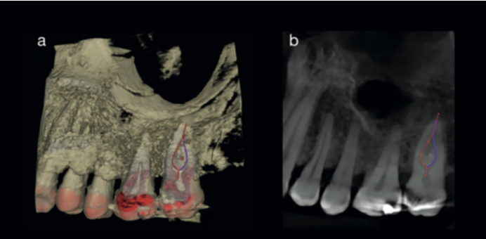 Fig. 3 — Root canal tracing tool showing two canals in the palatal root of UL7