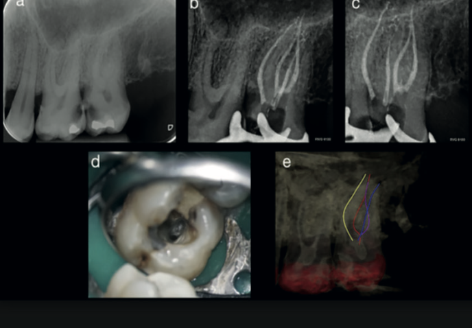 Fig. 4 — Pre-operative, mid-treatment, and operating microscope views showing the two palatal canals alongside the 3D root canal tracing