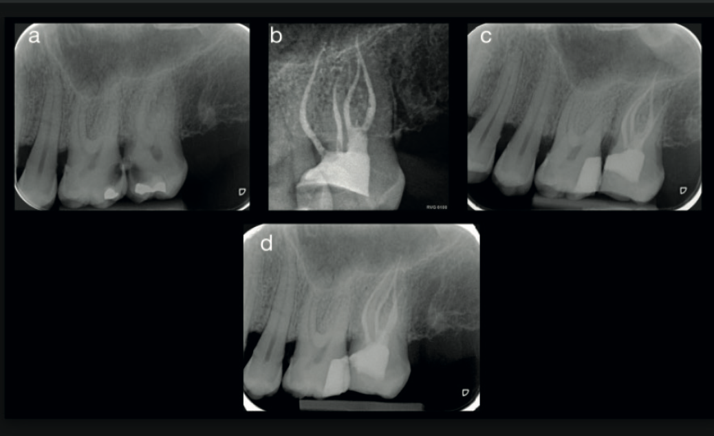 Fig. 5 — Pre-operative, post-operative, and two-year follow-up periapical radiographs showing successful treatment