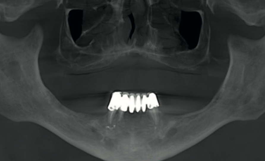 Reformatted panoramic CBCT view of an edentulous maxilla showing the full field of view