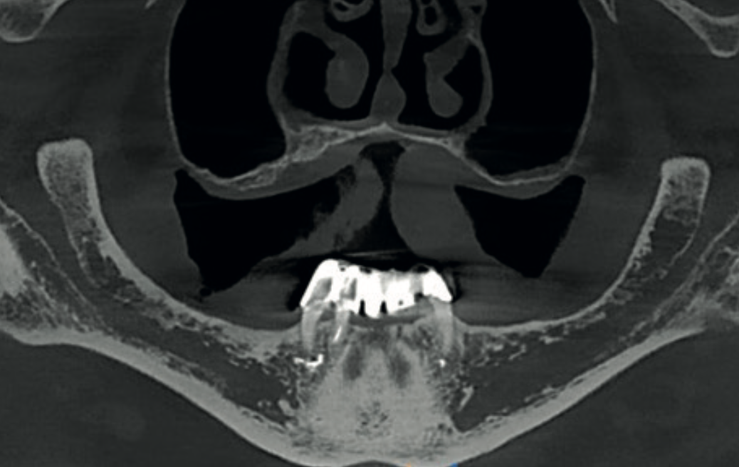Thin-slice panoramic view showing bone assessment for implant planning