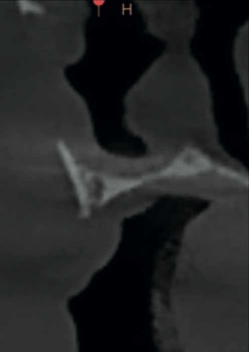 Cross-sectional views confirming minimal residual alveolar ridge height in the maxilla