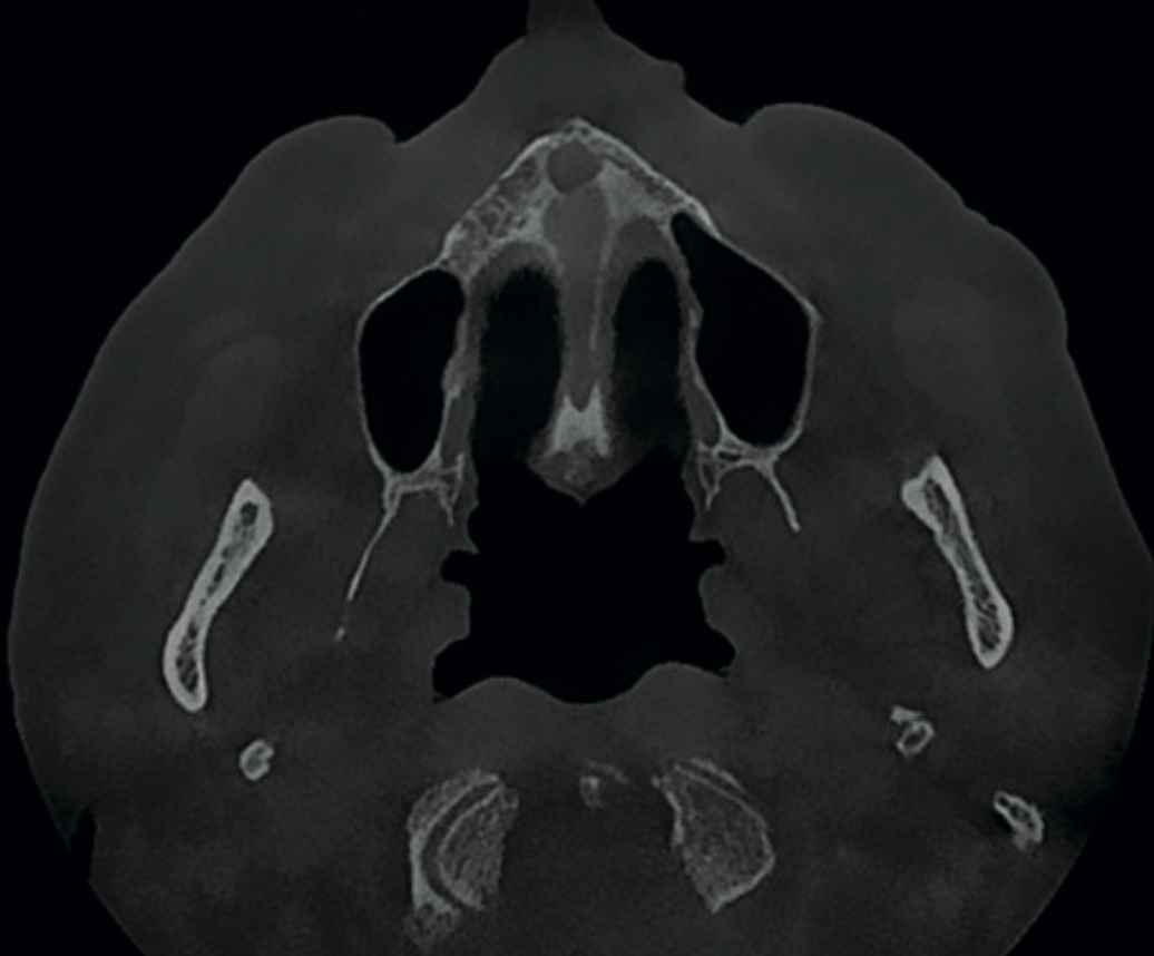Axial CBCT view showing enlarged incisive foramen suggestive of incisive canal cyst