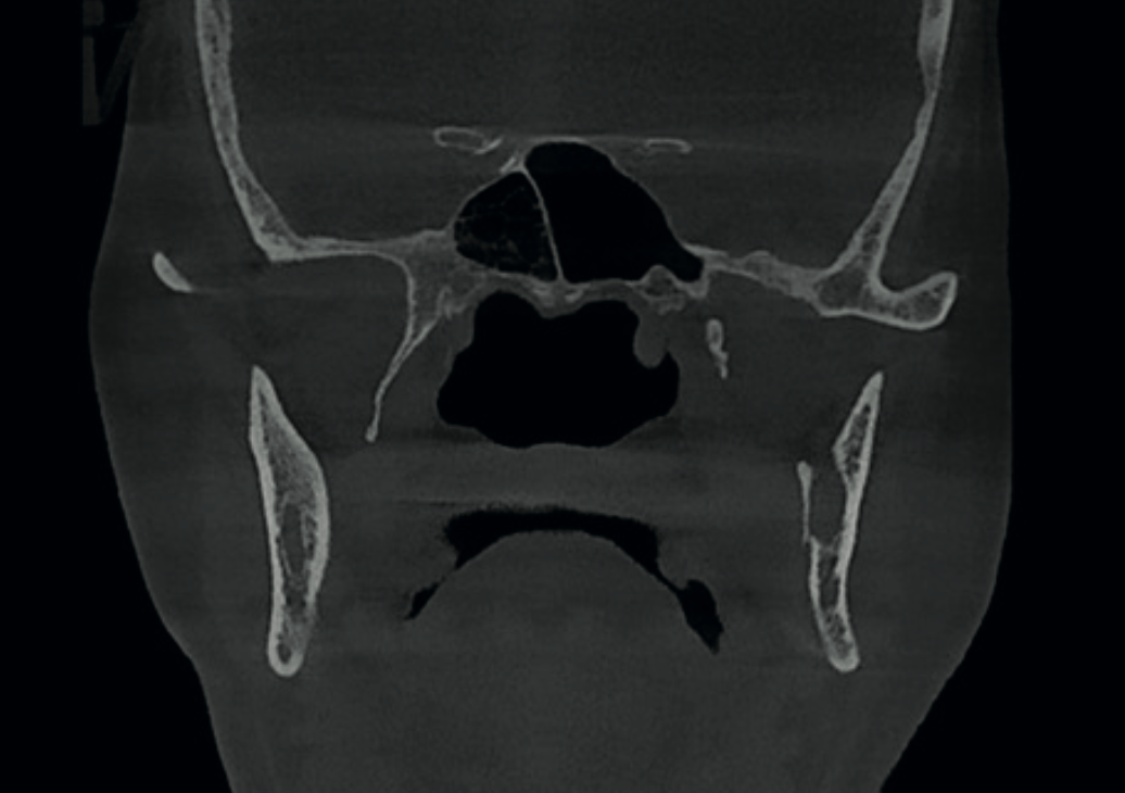 Coronal CBCT view showing streaks in the right compartment of the sphenoid sinus