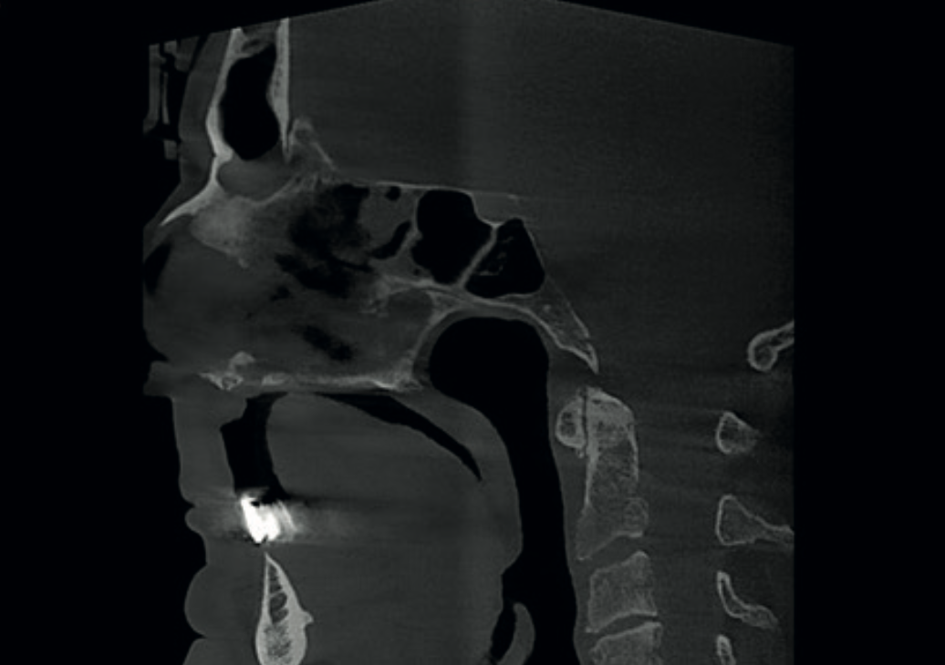 Sagittal CBCT view showing cervical spine osteoarthrosis at C1-C2 and C3-C4