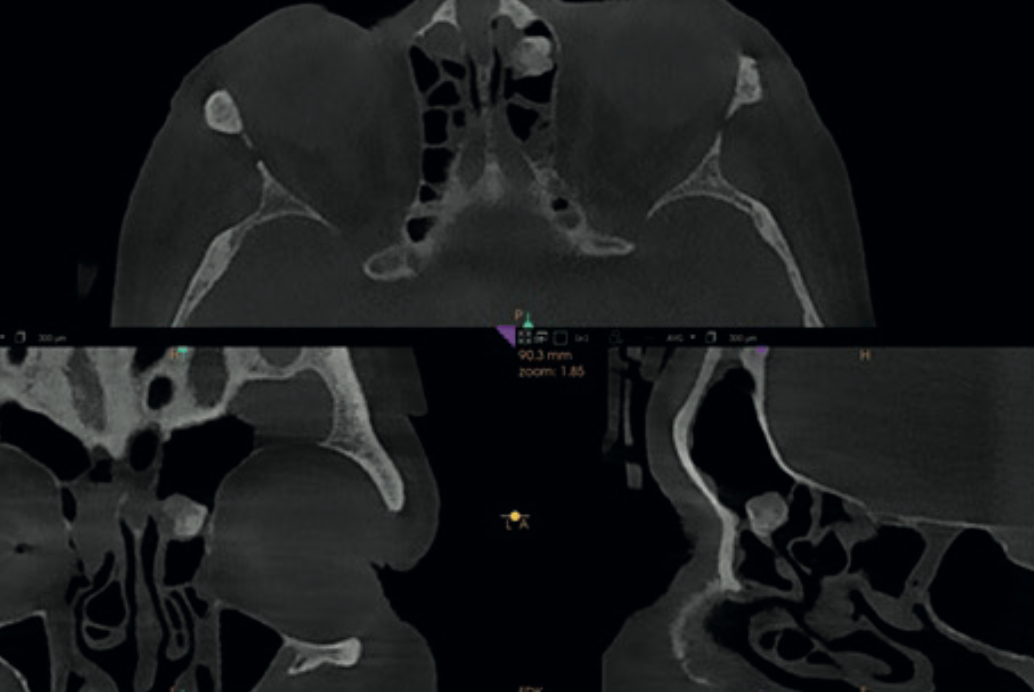 MPR views showing a well-defined bony lesion in the left anterior ethmoid cells — suspected osteoma