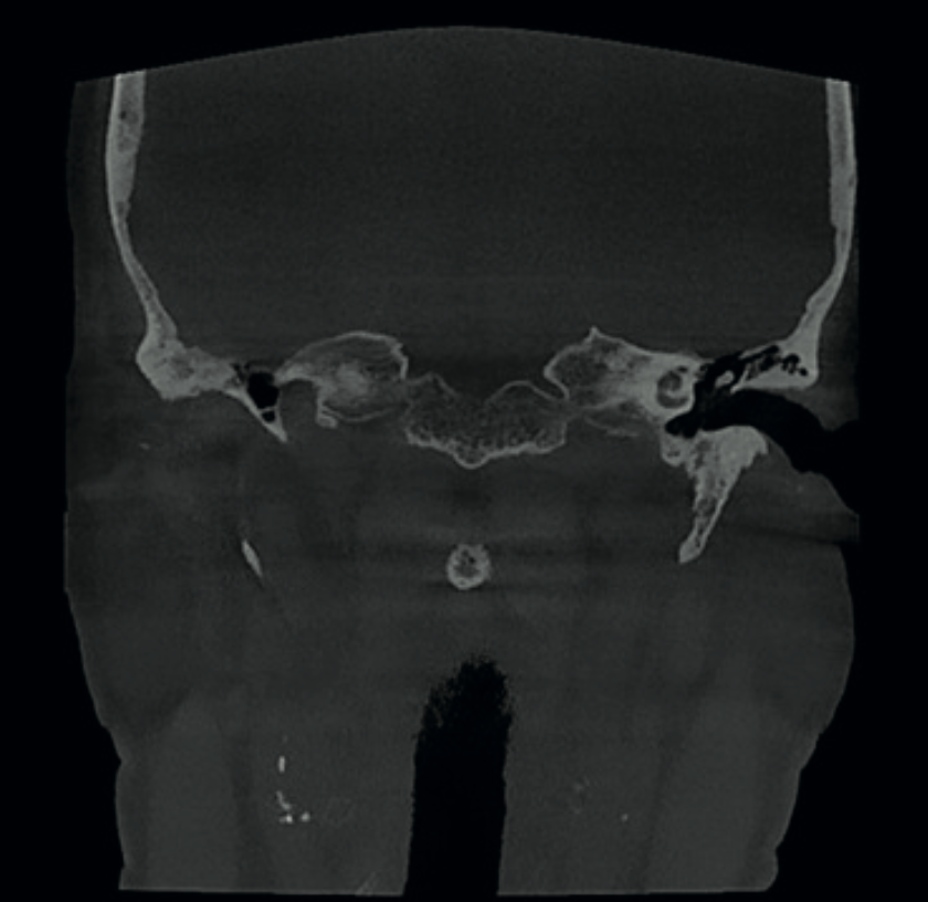 Coronal CBCT image showing bilateral calcifications in atheromatous plaques in the carotid arteries in the neck