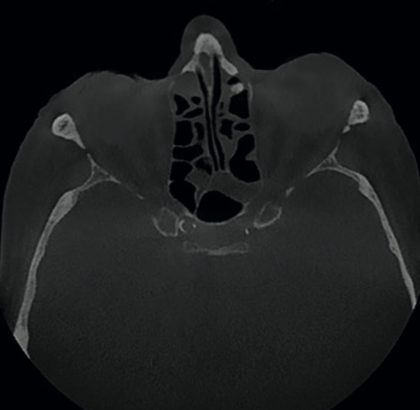 Axial CBCT image showing calcification in intracranial portions of the internal carotid arteries