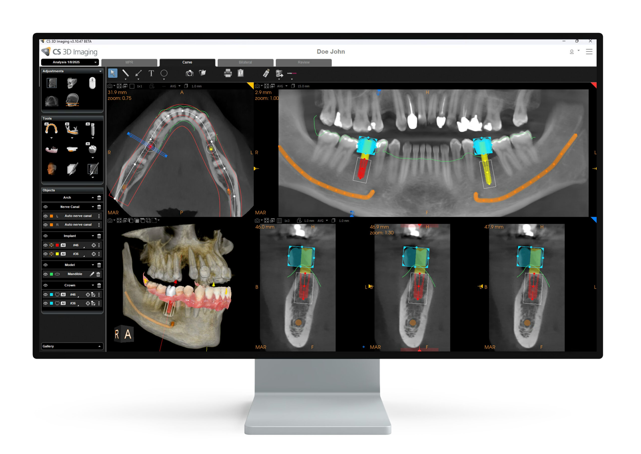 AI implant planning in CS 3D Imaging Premium