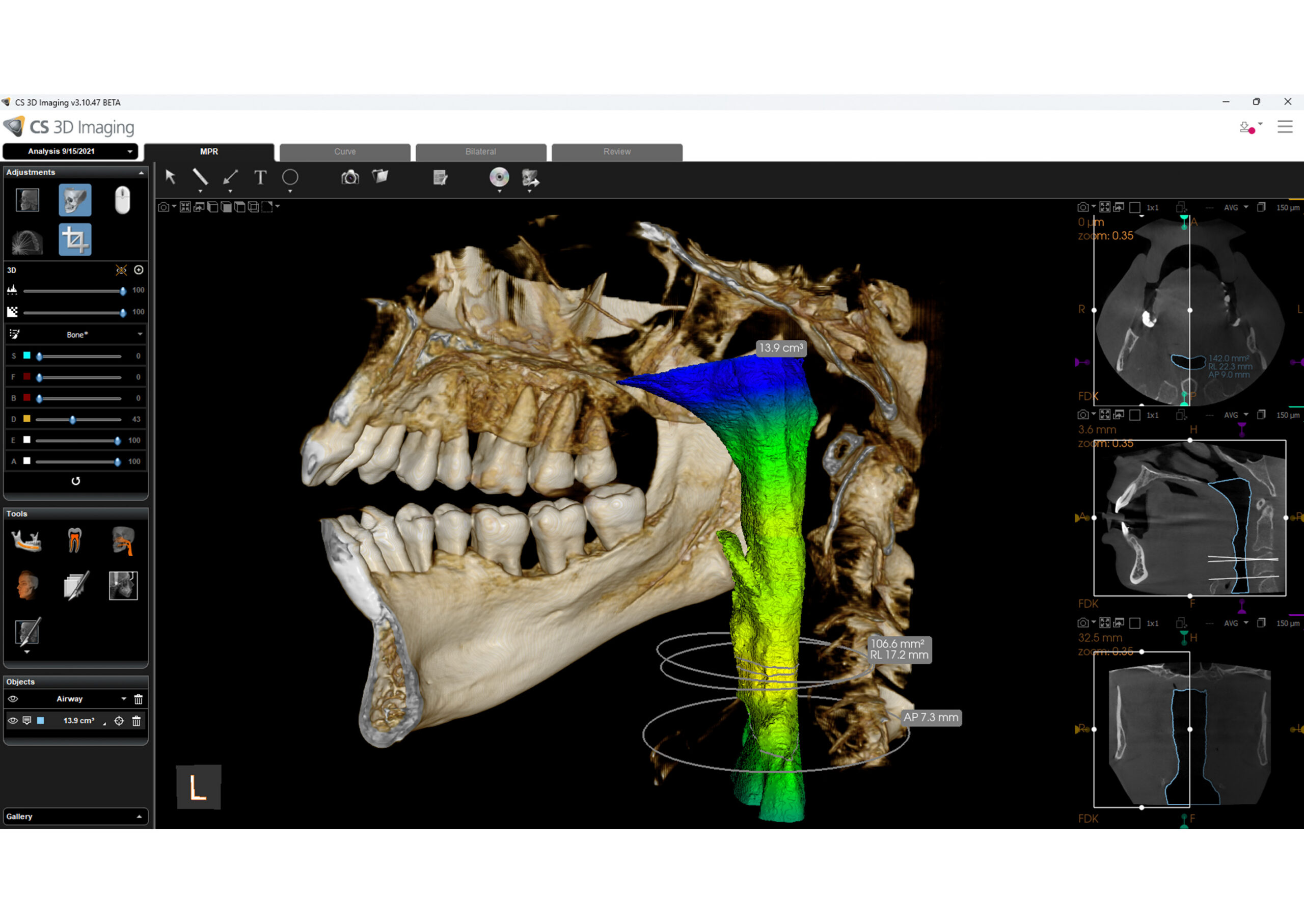 CS Airway module &mdash; airway analysis