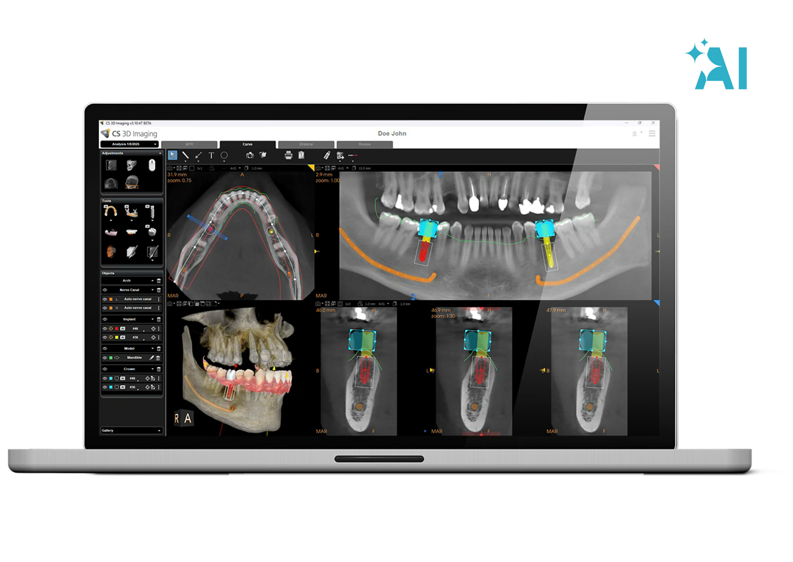 Step 3 &mdash; Plan implant