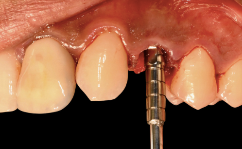 VARIOtemp abutment placed for the screw-retained temporary restoration