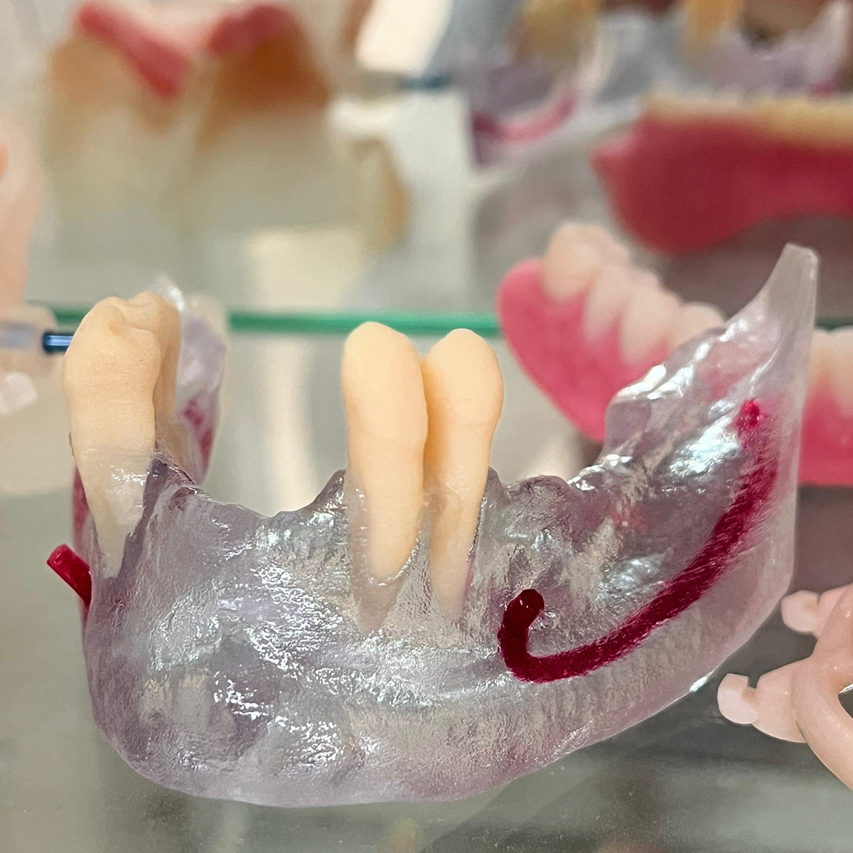 3D printed surgical guide