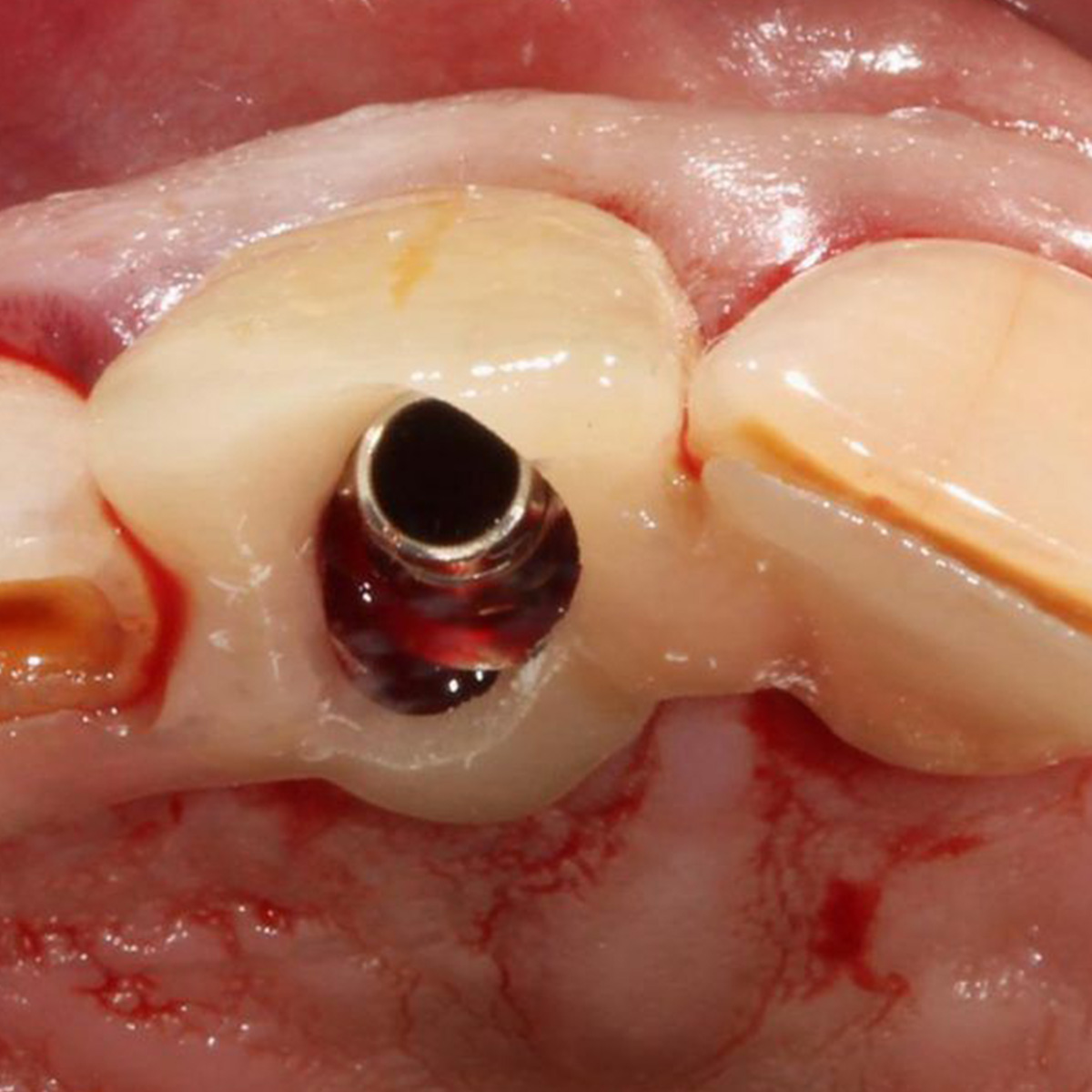 Guided implant placement
