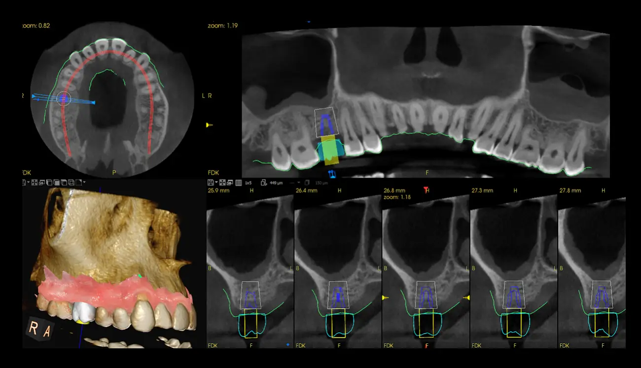 Implant planning module &mdash; CS Imaging software