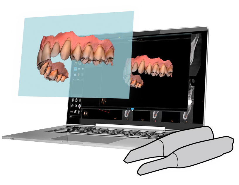 Seamless IO scanner integration with CBCT