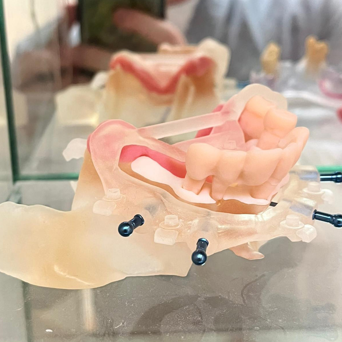 SMOP implant planning software