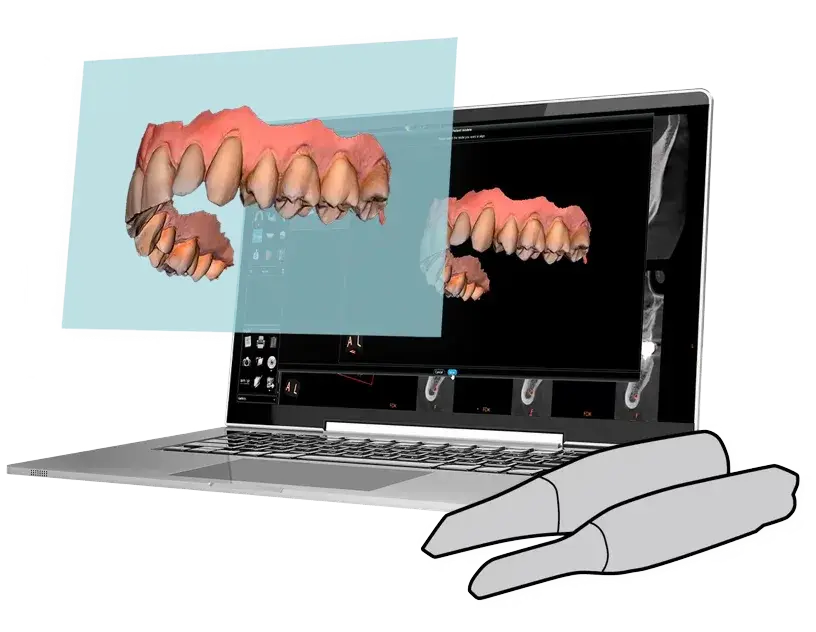 Intraoral scan aligned with the CBCT volume