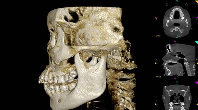 Full skull 3D render from a 16 x 17 cm Carestream CS 9600 CBCT scan